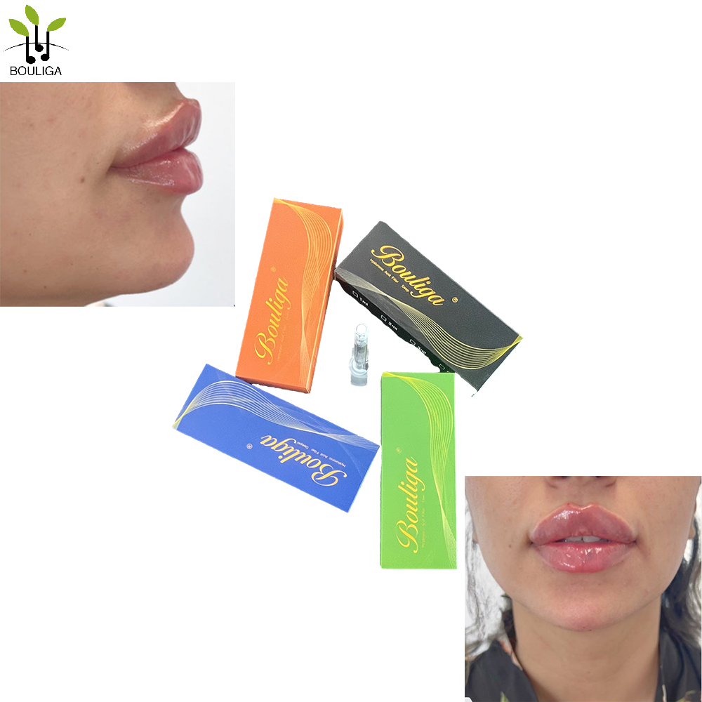 Bouliga Dermal filler 2ml 100% hyaluronzuur 20mg/ml concentratie voor Lip Glow Up