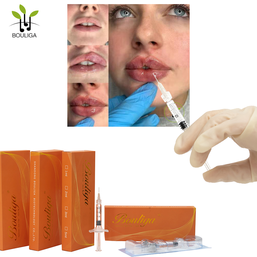 Bouliga Cross-linked hyaluronzuurvuller 1 ml 2 ml 5 ml 10 ml gebruik voor volumineuze lippen 4